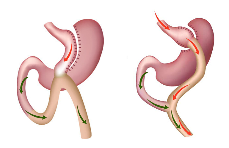 Gastric Bypass