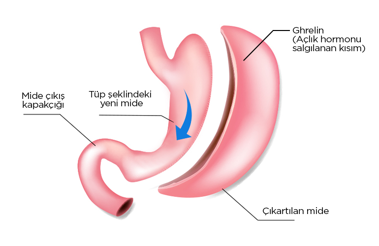 Gastric Sleeve