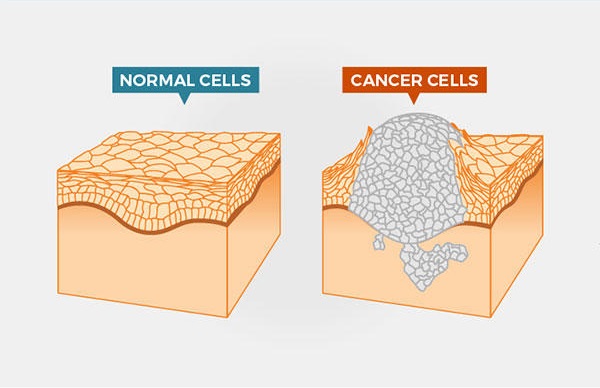 Kanser Nedir? Neden Olur?