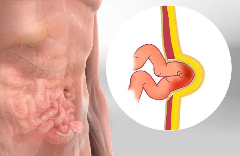 Hernia Diseases