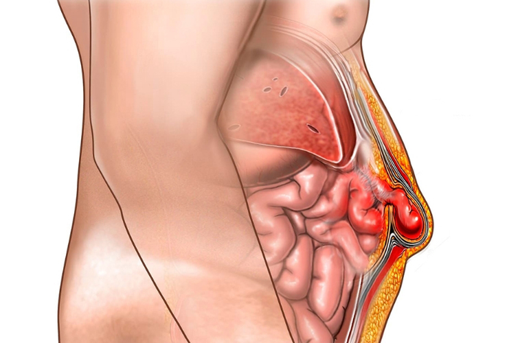 Abdominal Wall Hernia