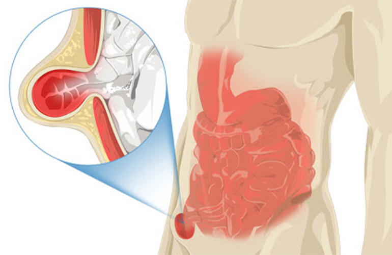 Inguinal Hernia