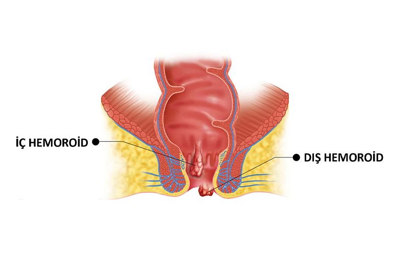 Hemoroid Nasıl Geçer?