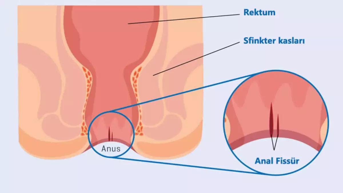 Anal Fissür (Makat Çatlağı)