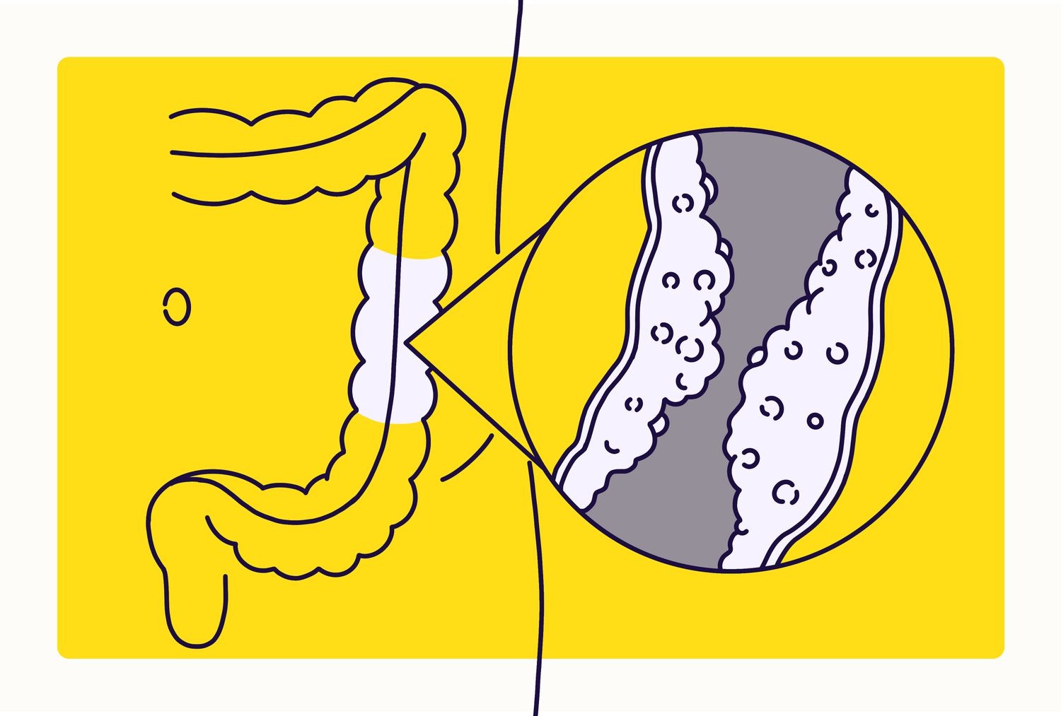 Crohn Hastaları Yorumları, Yasak Yiyecekler