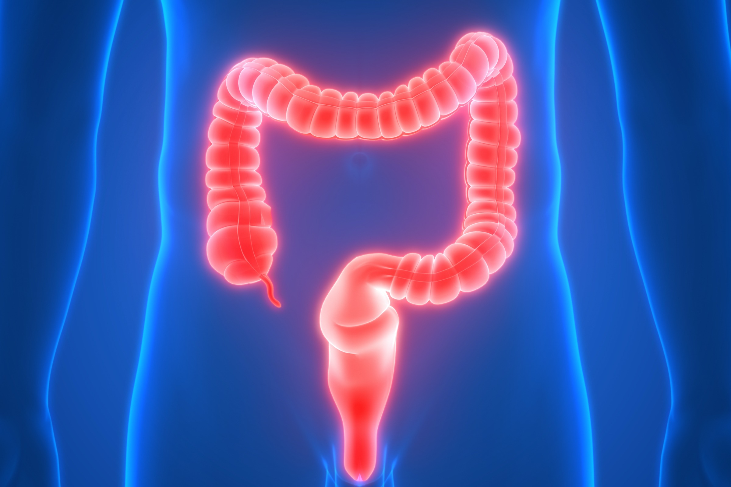 Ulcerative Colitis