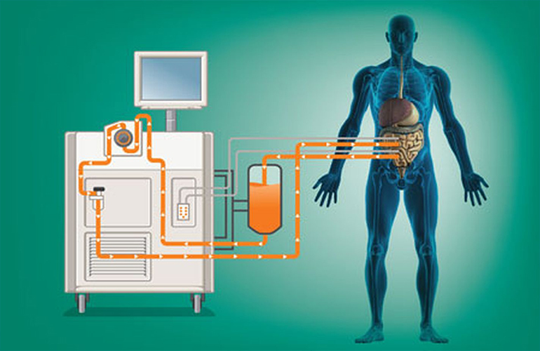 Cytoreductive Surgery and Hipec